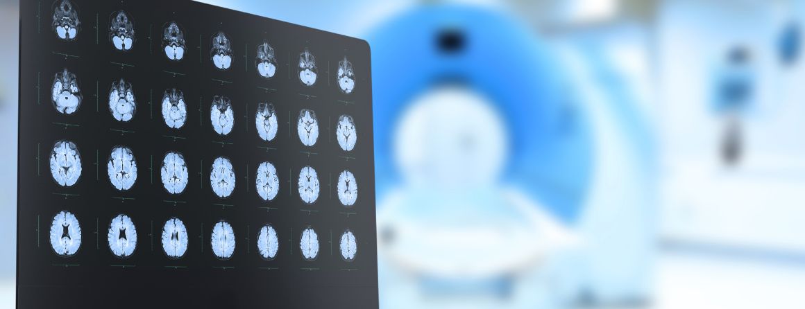 MRI brain scan