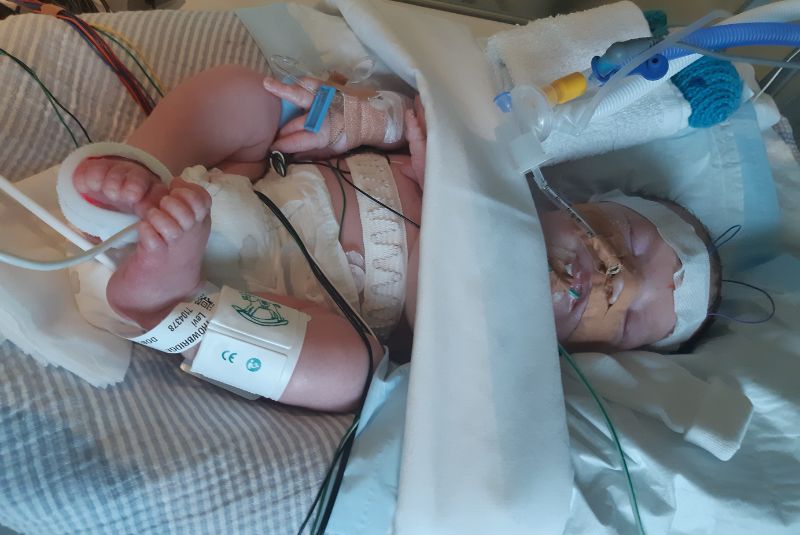 Epilepsy patient Levi as a baby