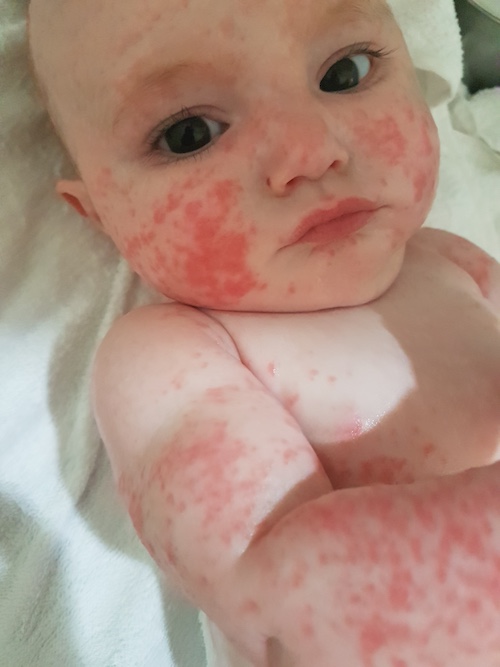 RAG-1 SCID Patient Olympia with a painful rash