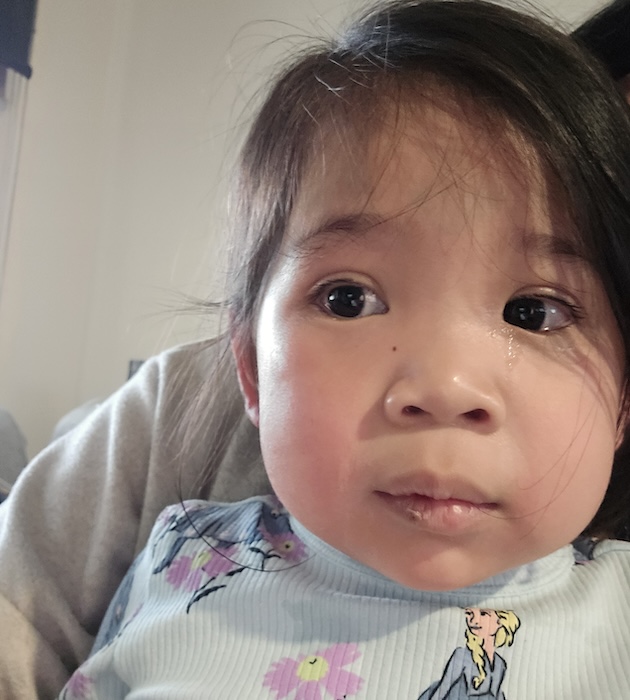 Emilia’s face swelled up during an allergic reaction the day after her party