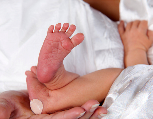 Newborn babies feet with heel prick marks to test for Fragile X syndrome