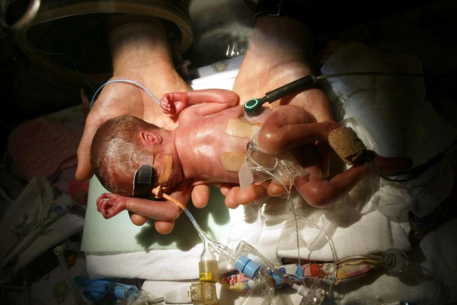 Caffeine boosts long-term breathing for very premature babies