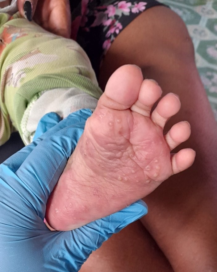 Foot with scabies symptoms
